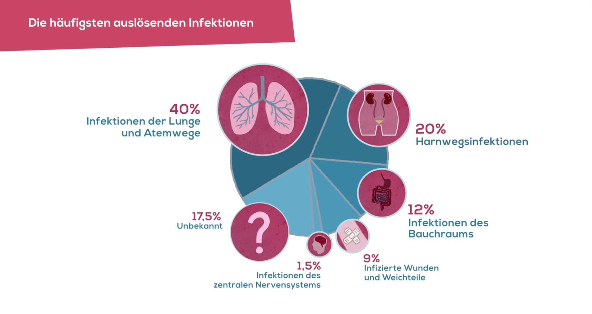 Kreisdiagramm „Die häufigsten auslösenden Infektionen“ mit Anteilen von Lunge, Harnwegen und Bauchraum